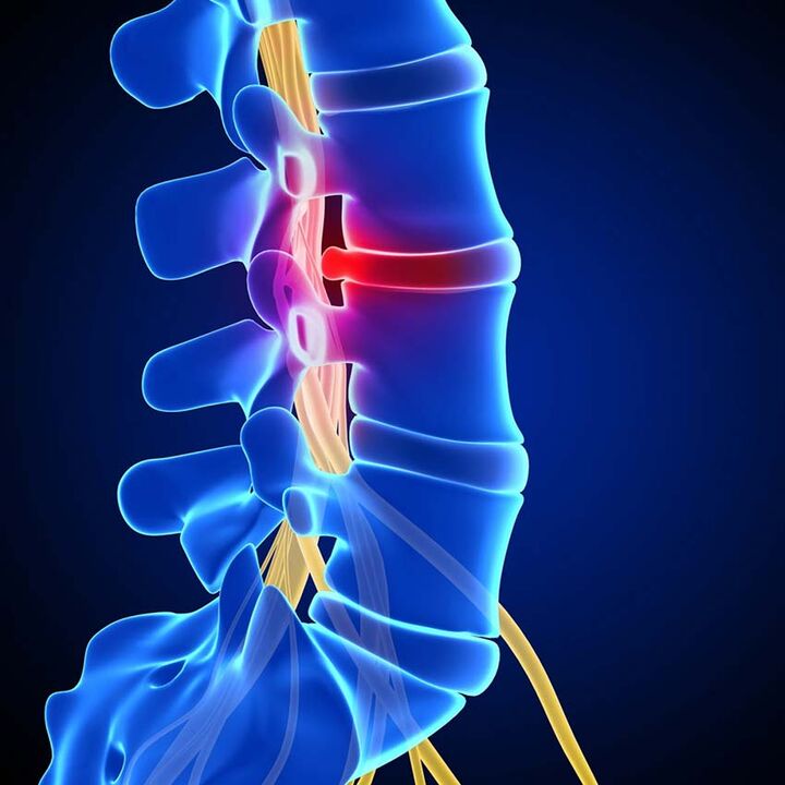 segít az osteochondrosisban)